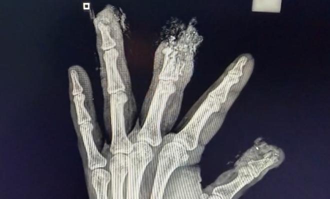 radiografia de una mano con una lesion severa
